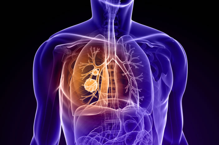 Lung cancer is by far the leading cause of cancer death in men and women. But lung cancers ¿ even specific types such as small-cell or non-small cell lung cancers ¿ are not all the same.